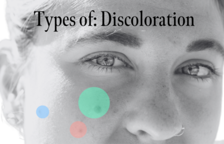 Types of Skin Discoloration & How to Get Rid of Them Fast