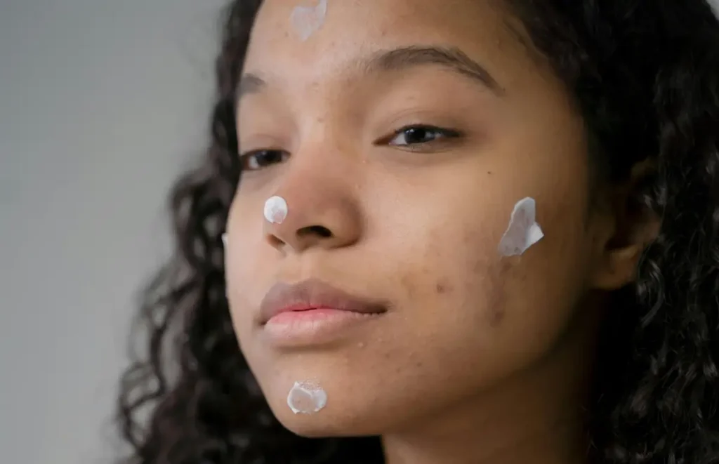 Does Azelaic Acid Cause Purging? – Beautiful With Brains