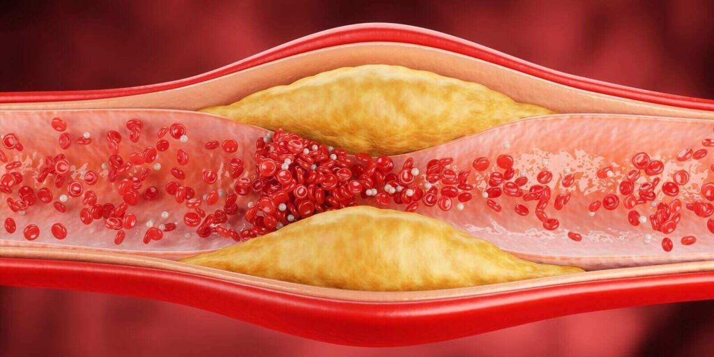 Why High Cholesterol Often Has No Symptoms