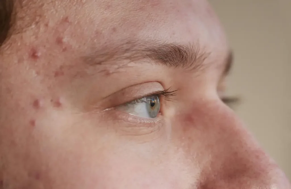 Pimples On Temples Meaning – Beautiful With Brains