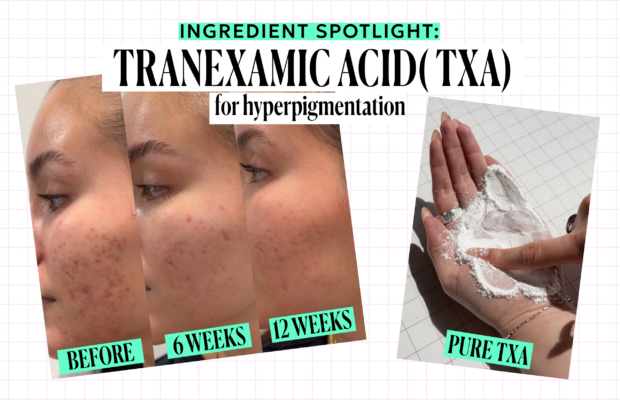Tranexamic Acid – Esthetician Approved Ingredient
