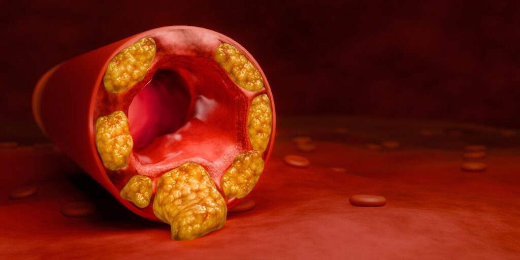 High Cholesterol: Understanding the Types and Taking Control