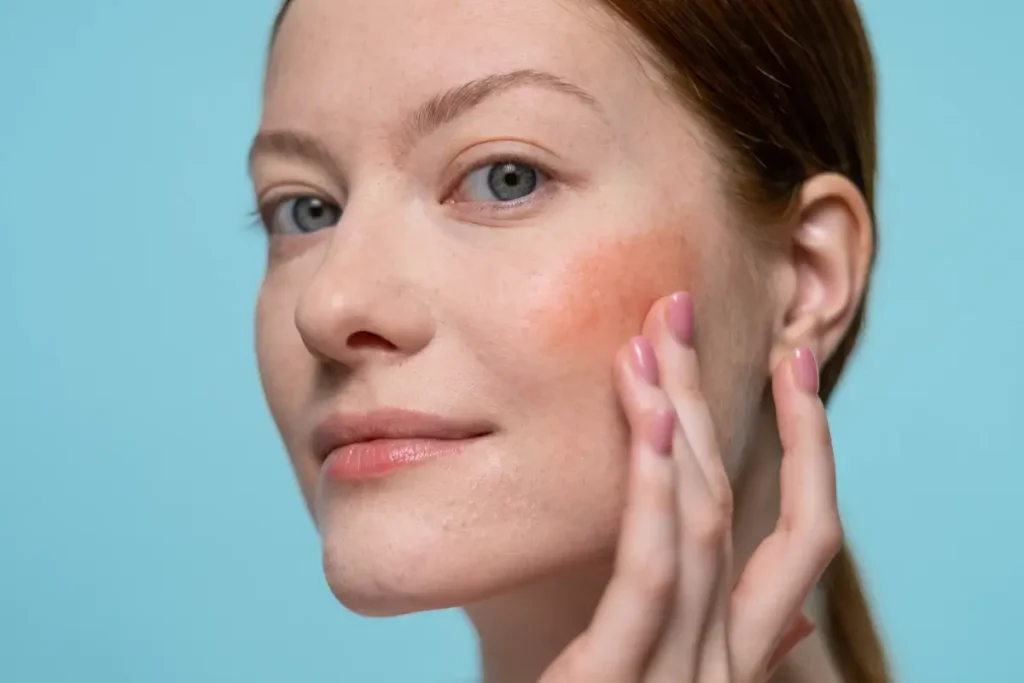 Does Korean Skincare Actually Help Rosacea? – Beautiful With Brains