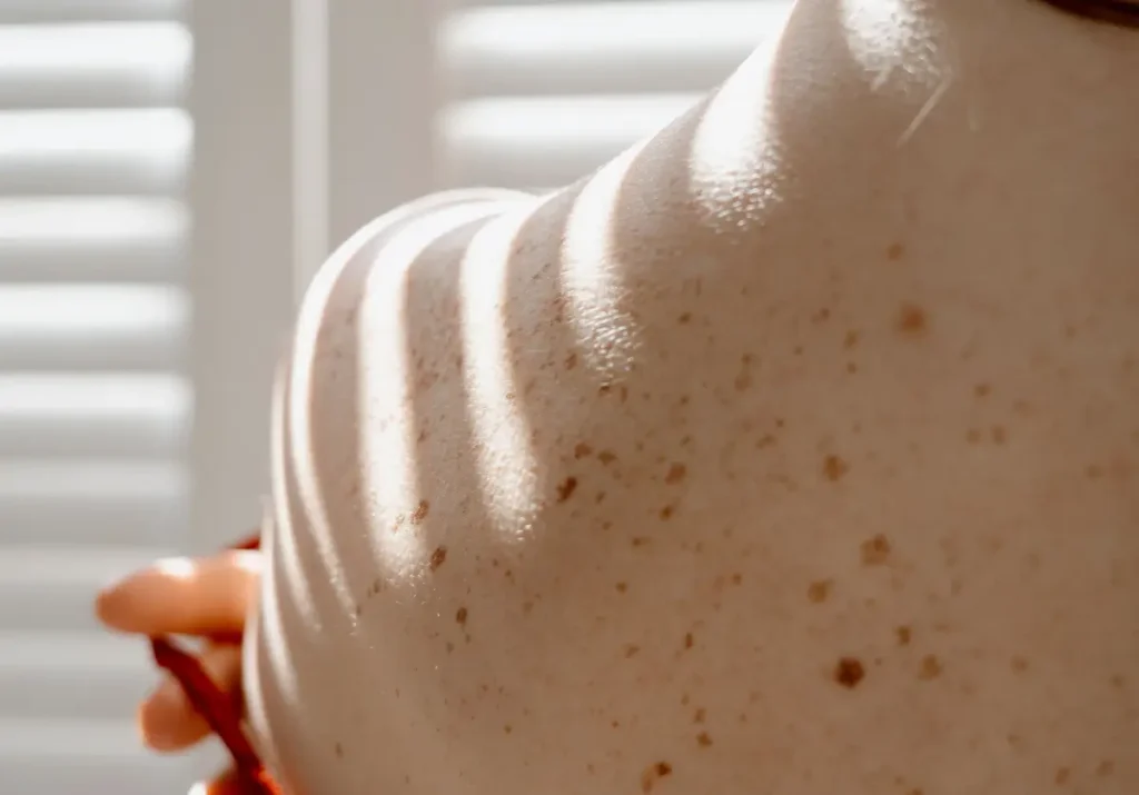Does Sunscreen Get Rid Of Dark Spots? – Beautiful With Brains