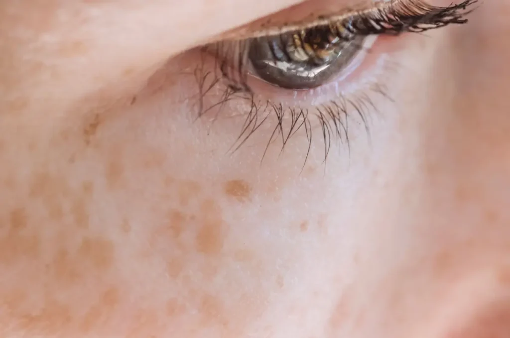 Does Microneedling Help With Hyperpigmentation? – Beautiful With Brains