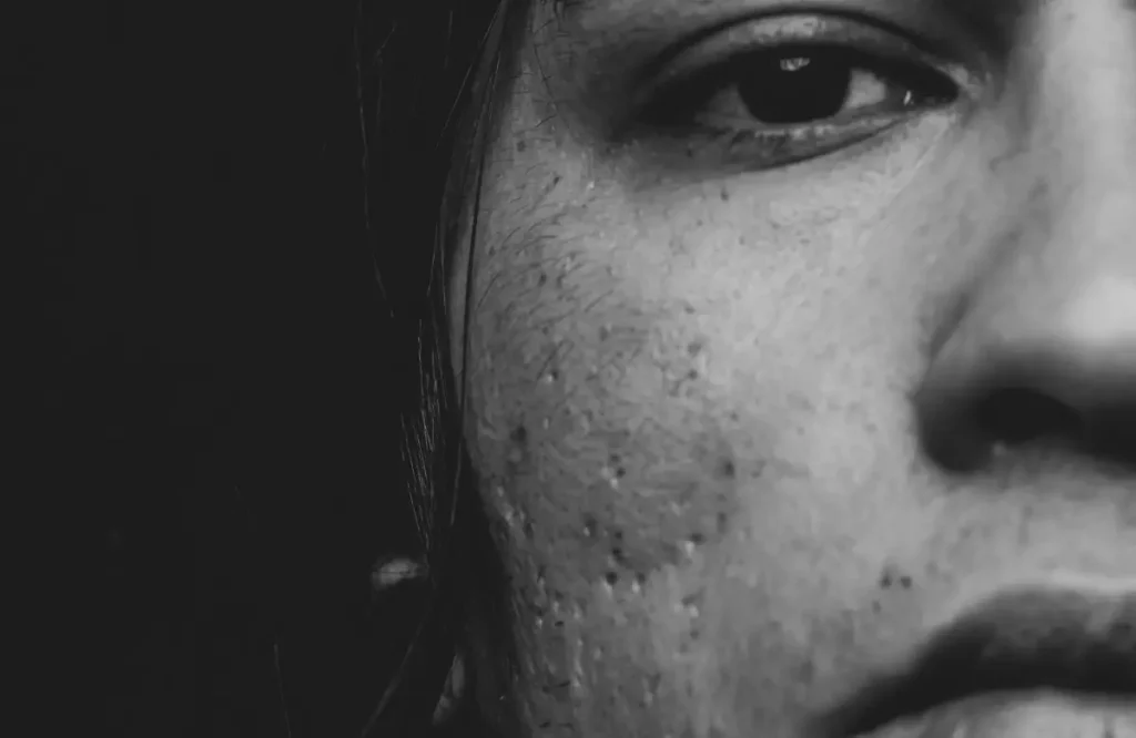 Does Adapalene Help With Acne Scars? What Science Says – Beautiful With Brains